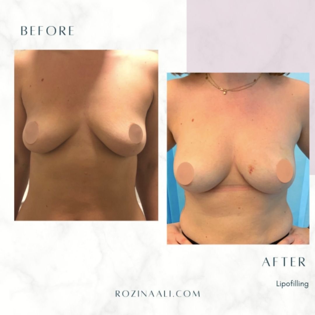 fat transfer to breast surgery private clinic UK