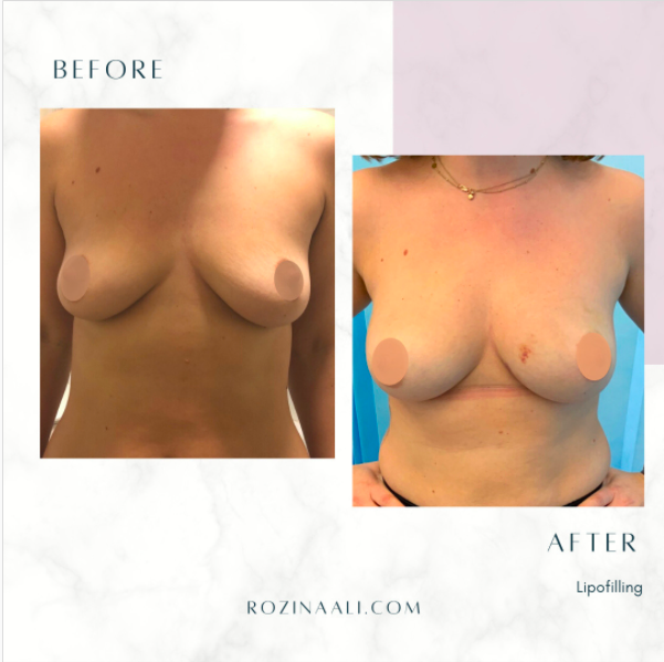 before-and-after-breast-augmentation-fat-transfer