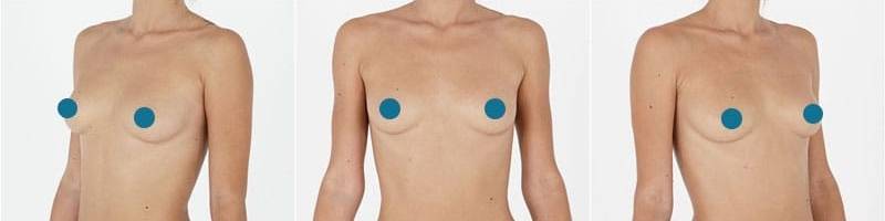 example_breast